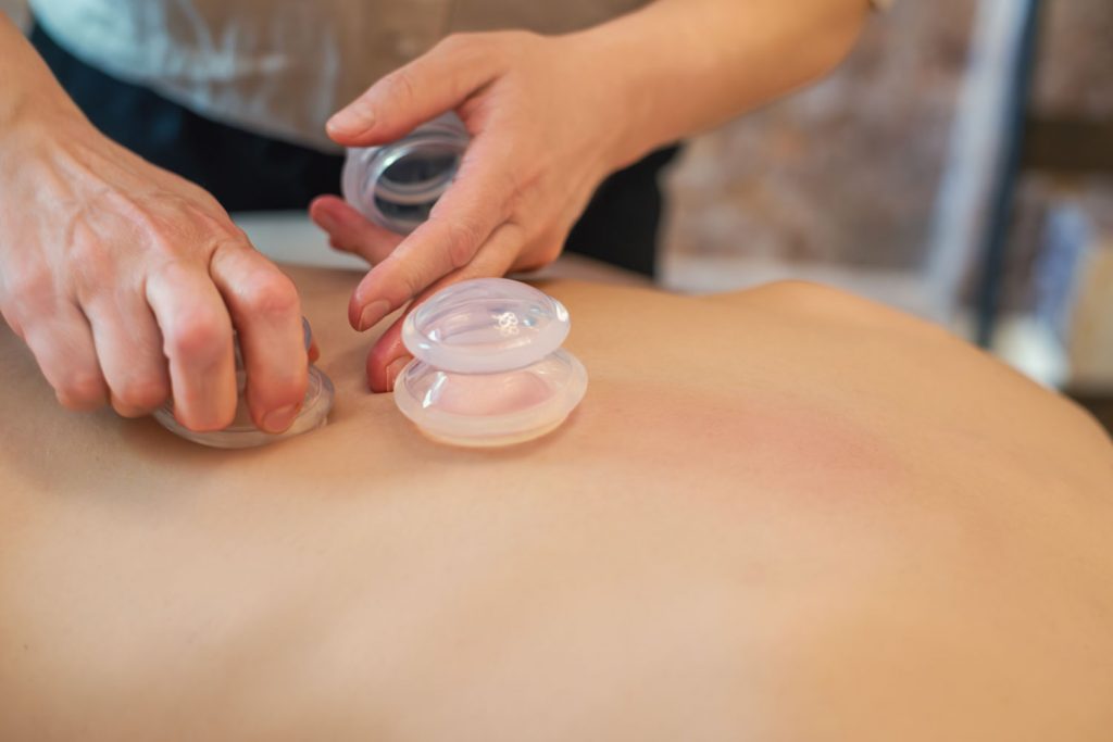Susan Mehr schröpft den oberen Rücken einer Kundin während der Schröpfmassage