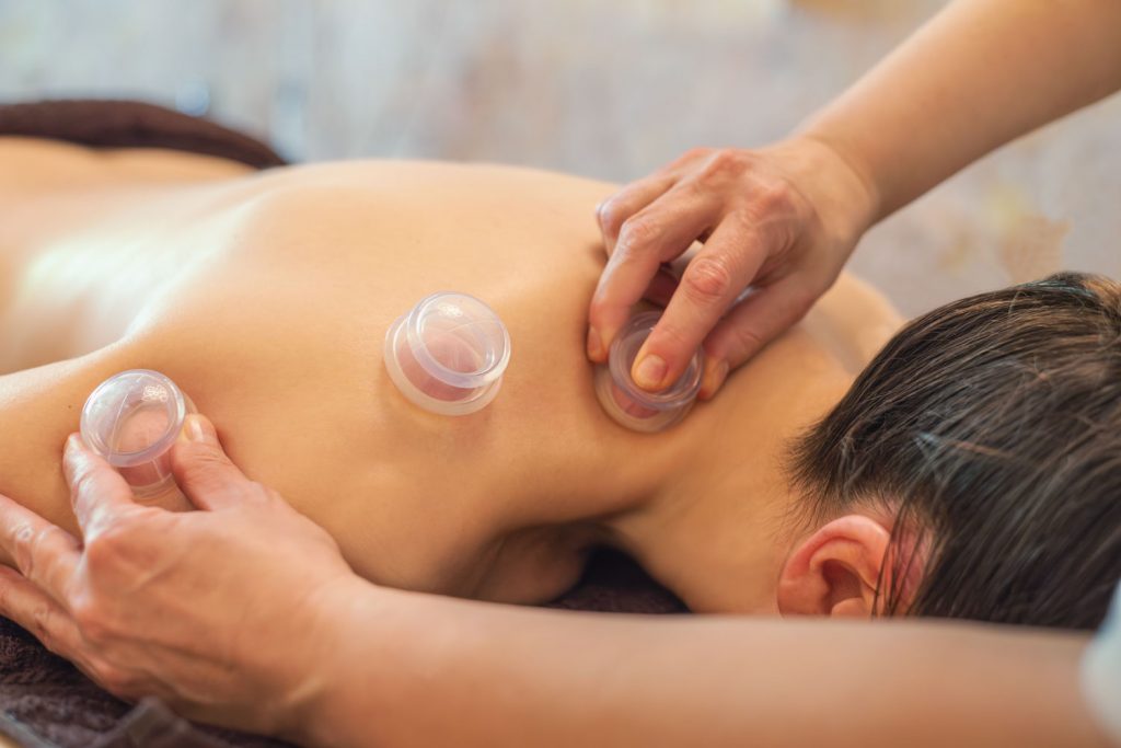 Susan Mehr platziert kleine Schröpfgläser entlang der Schulter einer Kundin während der Schröpfmassage
